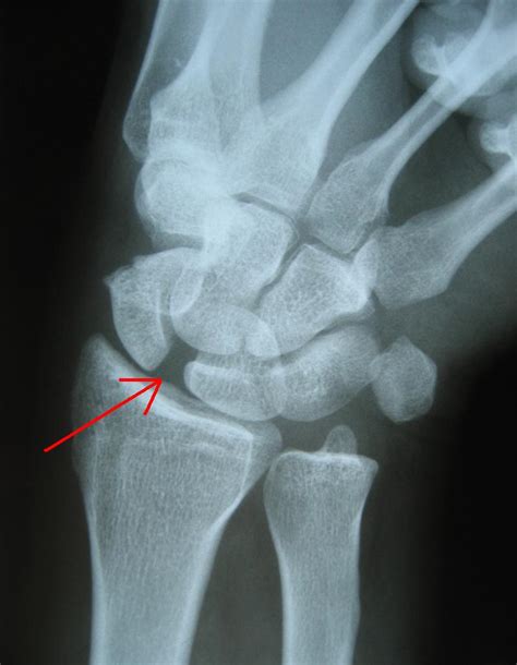 scapholunate ligament rupture